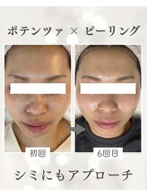 リノ ショウナン(LINO SHONAN)/ポテンツァ×ハーブピーリング