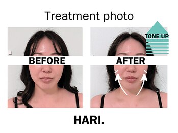 ハリドット 天王寺院(HARI.)/美顔鍼+フェイシャル 20代