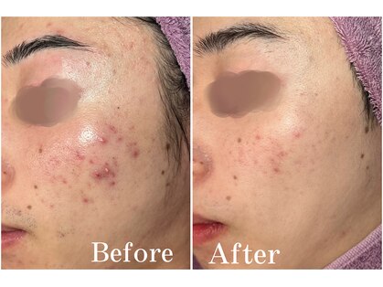 ディンプル(Dimple)の写真
