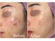 ディンプル(Dimple)の写真