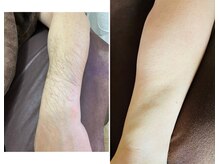 カフー(KAFUU)/【腕のビフォーアフター】