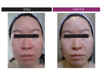 パーフェクトフェイスビューティー 梅田店(PERFECT FACE BEAUTY)/ディレイアコスメ（1種）使用