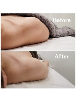 ペルル(Perle)/筋膜リリース ハンド