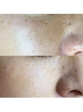 ミーミー 多治見店(MeMe.)/シミケア