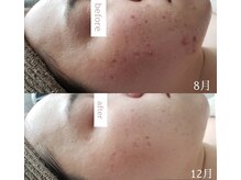 プシュケ(Psyche)/お客様の肌変化