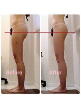 ピーエフ トウキョウ(PF TOKYO)/ハイパーナイフEX＆美容整体