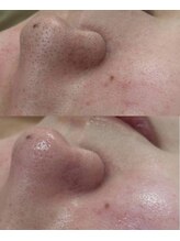 ミュー 多治見店(mieux)/◆肌質改善例