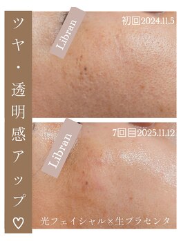 リブラン(Libran)/ごわつき肌から柔らかいモチ肌へ