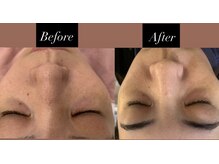 アミティエ 恵比寿駅前店(Amitie)/【症例】毛穴洗浄×美白パック