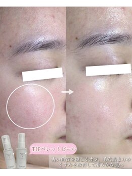 ラボーテエサンテ バイ ティアラ(la beaute et sante by Tiara)/TIPパレットピールでなめらか肌