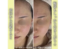 ハニエル(Haniel)/カーボキシー症例