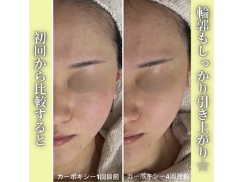 ハニエル(Haniel)/カーボキシー症例