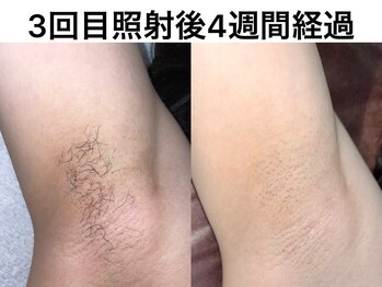 モンクール(Mon Coeur)の写真/【脱毛デビューはココ！】完全個室のプライベート空間で、低価格＆都度払いのお手軽美肌ケアをスタート＊