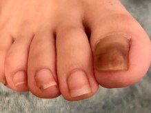 ネイルサロンアンドスクール シーグリーン(SEAGREEN)/【お悩み事例】足の爪の変色