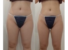 クレール アオヤマ(CLAIRE AOYAMA)/【6回】ムクミ+脂肪ドバっと排出