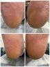 【フットケア】ガサガサかかとでお悩みの方足裏角質ケア　30分コース　