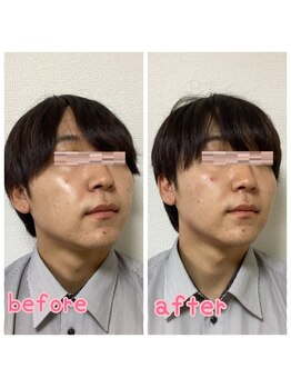 小顔整体 優/スッキリフェイスライン☆