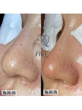 ピュール 鯖江店(PUR)/毛穴サロン/毛穴ケア