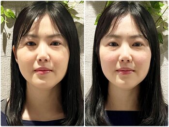 ア ムーン ドロップ(a Moon Drop)/施術前後の印象の違い