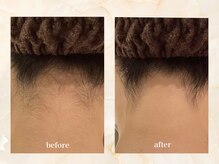 セーラマーレ(cera-mare Esthetic by CARDIA)/ブライダルシェービング　うなじ