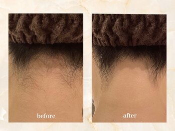 セーラマーレ(cera-mare Esthetic by CARDIA)/ブライダルシェービング　うなじ