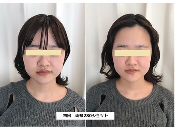 ナチュレアンドメディカ(Nature&Medica)/【たるみor小顔】ソフウェーブLT