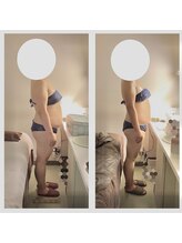 アクア エステティコ 亀有(ACQUA estetico)/上半身　3ヶ月変化　40代