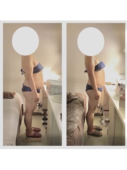 アクア エステティコ 亀有(ACQUA estetico)/上半身 3ヶ月変化 40代