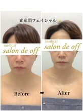 メディカルサロンドオフ 堺東店(medical salon de off)/光造顔フェイシャル★ &nbsp;施術前後