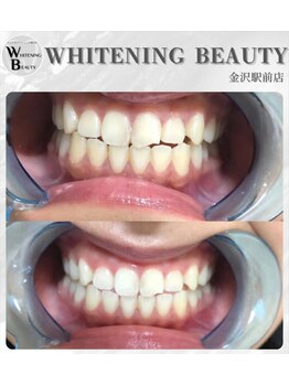 ホワイトニングビューティー 金沢駅前店(WHITENING BEAUTY)/汚れが取れるとイメージが変わる