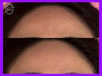 ヴィオール 名古屋栄店(VIOR)/肌質改善しながら産毛脱毛効果◎