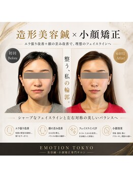 エモシオン トウキョウ(EMOTION TOKYO)/造形美容鍼×小顔矯正