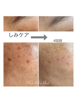 カミーシャ(KaMi-Sha)/【40代女性】シミケア症例写真