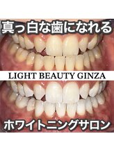 ライトビューティー 銀座店(LightBeauty)/東銀座 ホワイトニング症例写真