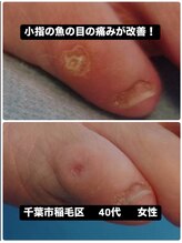 巻き爪じゅん 千葉駅前店/魚の目の痛みが当院の施術で改善