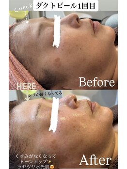 ハレアンド(Hare&)/ダクトピール1回目Before After