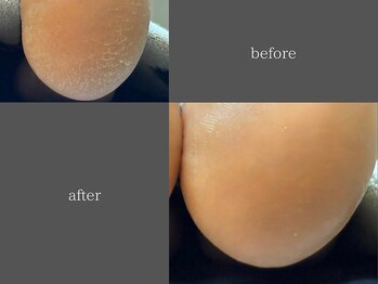テリー(Terry)/韓国式足裏角質ケアbefore after