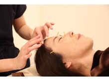 きらり整体/【施術】美容鍼