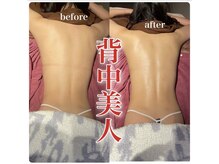 【ハーブピーリング】お顔はもちろん◎背中、お尻まで綺麗に☆