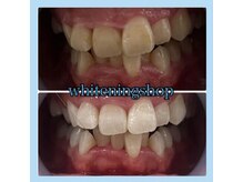 ホワイトニングショップ 天王寺店/10回ご来店後のお写真です