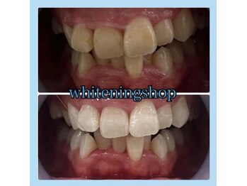 ホワイトニングショップ 天王寺店/10回ご来店後のお写真です