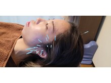 羅針堂鍼灸整体院 横浜鶴見店/鍼灸の実際の施術風景【鍼灸院】