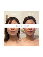 リルシープ(LIL'SHEEP)/眠れる小顔コルギ1回施術