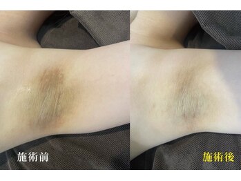 アネル 美里店(anel)/プラズマ脱毛