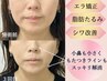 《月5名限定》糸リフト不要!!たるみ改善★小顔矯正＋首肩リンパ[面長矯正]　