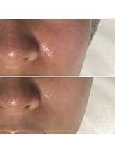 レアリゼ(Realiser)/赤み/痒みもクリスティーナで