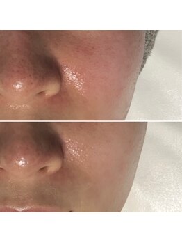 レアリゼ(Realiser)/赤み/痒みもクリスティーナで