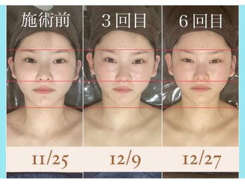 千歳の女神 岡崎店/【施術風景】Before/After