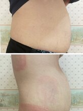 ルフレ/★大人気【脂肪冷却】お腹