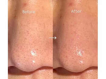 ビナリ 東銀座(BINARI)の写真/毛穴の奥の皮脂詰まりや黒ずみを徹底ケア★≪毛穴洗浄フェイシャル(毛穴吸引+保湿マスク)¥5,500≫